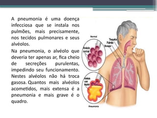 Aula pneumonia.,......................pptx