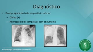 Diagnóstico
• Doença aguda do trato respiratório inferior
– Clínica (+)
– Alteração do Rx compatível com pneumonia
 