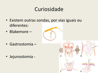Curiosidade
• Existem outras sondas, por vias iguais ou
diferentes:
• Blakemore –
• Gastrostomia –
• Jejunostomia -
 