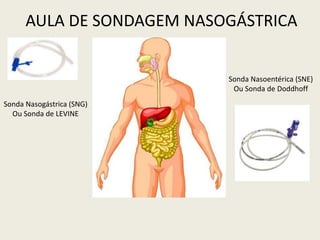 Sonda Nasogástrica (SNG)
Ou Sonda de LEVINE
Sonda Nasoentérica (SNE)
Ou Sonda de Doddhoff
AULA DE SONDAGEM NASOGÁSTRICA
 