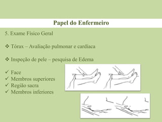Papel do Enfermeiro
5. Exame Físico Geral
 Tórax – Avaliação pulmonar e cardíaca
 Inspeção de pele – pesquisa de Edema
 Face
 Membros superiores
 Região sacra
 Membros inferiores
 