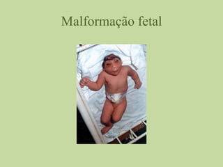 Malformação fetal
 