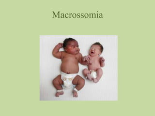 Macrossomia
 