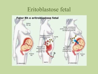 Eritoblastose fetal
 