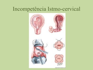 Incompetência Istmo-cervical
 