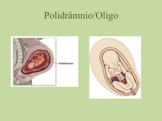 Polidrâmnio/Oligo
 