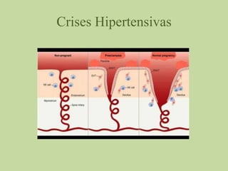 Crises Hipertensivas
 