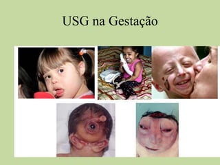 USG na Gestação
 