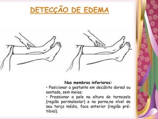 DETECÇÃO DE EDEMA
Nos membros inferiores:
• Posicionar a gestante em decúbito dorsal ou
sentada, sem meias;
• Pressionar a pele na altura do tornozelo
(região perimaleolar) e na perna,no nível do
seu terço médio, face anterior (região pré-
tibial).
 