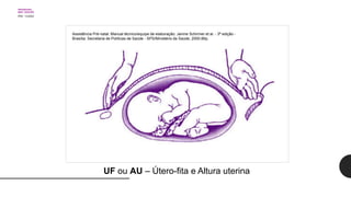 Assistência Pré-natal: Manual técnico/equipe de elaboração: Janine Schirmer et al. - 3ª edição -
Brasília: Secretaria de Políticas de Saúde - SPS/Ministério da Saúde, 2000.66p.
UF ou AU – Útero-fita e Altura uterina
 