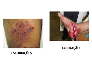 ESCORIAÇÕES
LACERAÇÃO
 