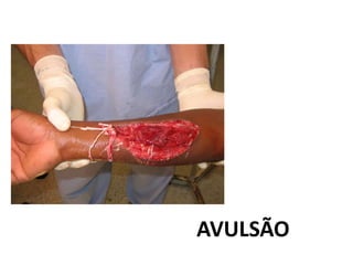 AVULSÃO
 