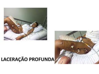 LACERAÇÃO PROFUNDA
 