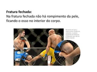 Fratura fechada:
Na fratura fechada não há rompimento da pele,
ficando o osso no interior do corpo.
 