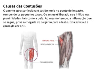 Causas das Contusões
O agente agressor lesiona o tecido mole no ponto de impacto,
rompendo os pequenos vasos. O sangue é liberado e se infiltra nas
proximidades, tais como a pele. Ao mesmo tempo, a inflamação que
se segue, priva a chegada de oxigênio para a lesão. Esta asfixia é a
causa da cor azul.
 