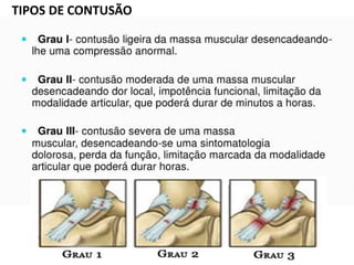 TIPOS DE CONTUSÃO
 