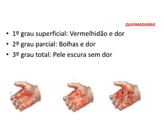 QUEIMADURAS
• 1º grau superficial: Vermelhidão e dor
• 2º grau parcial: Bolhas e dor
• 3º grau total: Pele escura sem dor
 