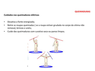 QUEIMADURAS
Cuidados nas queimaduras elétricas
• Desativa a fonte energizada;
• Retire as roupas queimadas ( se a roupa estiver grudada no corpo da vitima não
remova), brincos e anéis;
• Cuide das queimaduras com curativo seco ou panos limpos.
 