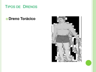TIPOS DE DRENOS
 Dreno Torácico
 