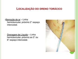 LOCALIZAÇÃO DO DRENO TORÁCICO
-Remoção de ar – Linha
hemiclavicular, próximo 2° espaço
intercostal.
- Drenagem de Líquido – Linha
hemiclavicular, próximo ao 5° ou
6° espaço intercostal.
 
