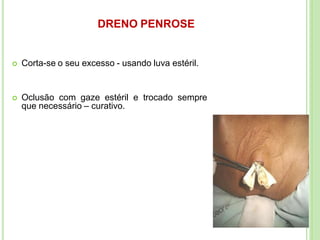 DRENO PENROSE
 Corta-se o seu excesso - usando luva estéril.
 Oclusão com gaze estéril e trocado sempre
que necessário – curativo.
 