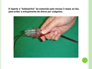 9- Aperte o “balãozinho” da extensão pelo menos 3 vezes ao dia,
para evitar o entupimento do dreno por coágulos;
 