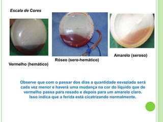 Escala de Cores
Amarelo (seroso)
Róseo (sero-hemático)
Vermelho (hemático)
Observe que com o passar dos dias a quantidade esvaziada será
cada vez menor e haverá uma mudança na cor do líquido que de
vermelho passa para rosado e depois para um amarelo claro.
Isso indica que a ferida está cicatrizando normalmente.
 