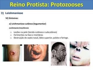 3) Leishmaniose
VI) Sintomas:
a) Leishmaniose cutânea (tegumentar)
Leishmania brasiliensis
o Lesões na pele (tecido cutâneo e subcutâneo)
o Ferimentos na face e membros
o Destruição do septo nasal, lábio superior, palato e faringe.
Reino Protista: Protozooses
 