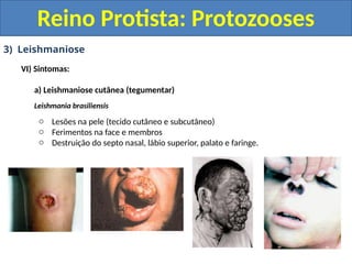 3) Leishmaniose
VI) Sintomas:
a) Leishmaniose cutânea (tegumentar)
Leishmania brasiliensis
o Lesões na pele (tecido cutâneo e subcutâneo)
o Ferimentos na face e membros
o Destruição do septo nasal, lábio superior, palato e faringe.
Reino Protista: Protozooses
 