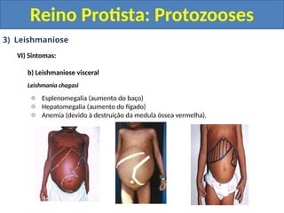 3) Leishmaniose
VI) Sintomas:
b) Leishmaniose visceral
Leishmania chagasi
o Esplenomegalia (aumento do baço)
o Hepatomegalia (aumento do fígado)
o Anemia (devido à destruição da medula óssea vermelha).
Reino Protista: Protozooses
 