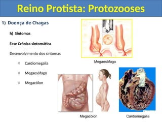 1) Doença de Chagas
h) Sintomas
Fase Crônica sintomática.
Desenvolvimento dos sintomas
o Cardiomegalia
o Megaesôfago
o Megacólon
Reino Protista: Protozooses
Megaesôfago
Megacólon Cardiomegalia
 