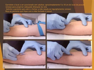Garroteie o local a ser puncionado (em adultos: aproximadamente 5 a 10 cm do local da punção
venosa) para propiciar adequada dilatação da veia
Solicite o paciente para abrir e fechar a mão (ajuda ao ingurgitamento venoso)
Peça ao paciente que fique com a mão fechada e imóvel
 
