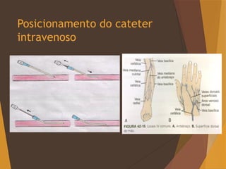 Posicionamento do cateter
intravenoso
 