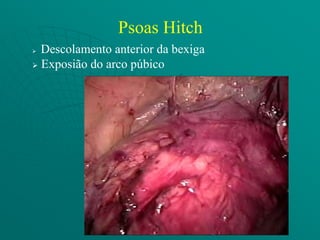 Psoas Hitch
 Descolamento anterior da bexiga
 Exposião do arco púbico
 