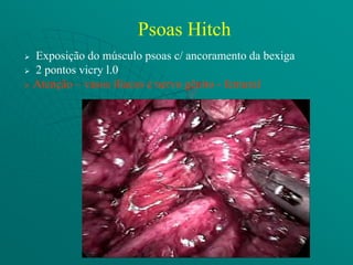 Psoas Hitch
 Exposição do músculo psoas c/ ancoramento da bexiga
 2 pontos vicry l.0

 Atenção – vasos ilíacos e nervo gênito - femural
 