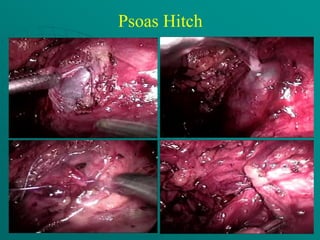 Psoas Hitch
 