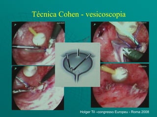 Técnica Cohen - vesicoscopia




              Holger Til –congresso Europeu - Roma 2008
 