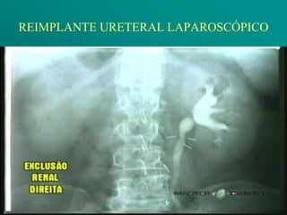 REIMPLANTE URETERAL LAPAROSCÓPICO
 