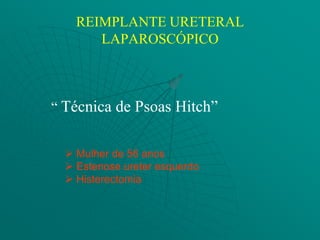 REIMPLANTE URETERAL
       LAPAROSCÓPICO



“ Técnica de Psoas Hitch”


   Mulher de 56 anos
   Estenose ureter esquerdo
   Histerectomia
 