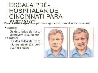 ESCALA PRÉ-
HOSPITALAR DE
CINCINNATI PARA
AVE/AVC
Paralisia Facial (peça ao paciente que mostre os dentes ou sorria)
• Normal
Os dois lados do rosto
se movem igualmente
• Anormal
Um dos lados do rosto
não se move tão bem
quanto o outro
 