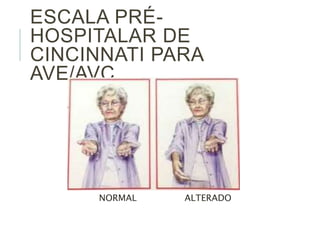ESCALA PRÉ-
HOSPITALAR DE
CINCINNATI PARA
AVE/AVC
NORMAL ALTERADO
 