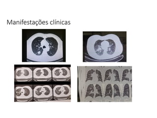 Manifestações clínicas
 