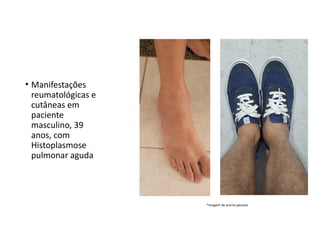 • Manifestações
reumatológicas e
cutâneas em
paciente
masculino, 39
anos, com
Histoplasmose
pulmonar aguda
*Imagem de acervo pessoal
 