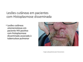 Lesões cutâneas em pacientes
com Histoplasmose disseminada
• Lesões cutâneas
ulcerocrostosas em
paciente HIV positivo
com histoplasmose
disseminada associada à
tuberculose pulmonar
*Imagem cedida gentilmente pela Drª Marcela Ramiro
 