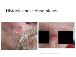 Histoplasmose disseminada
*Imagem cedida gentilmente pela Drª Marcela Ramiro
 