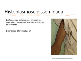 Histoplasmose disseminada
• Lesões papulo-eritematosas em paciente
masculino, HIV positivo, com Histoplasmose
disseminada
• Diagnóstico diferencial de SK
*Imagem cedida gentilmente pelo Dr° Dayvison Freitas
 