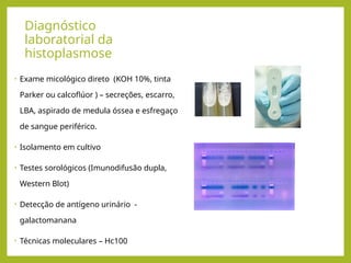 Diagnóstico
laboratorial da
histoplasmose
• Exame micológico direto (KOH 10%, tinta
Parker ou calcoflúor ) – secreções, escarro,
LBA, aspirado de medula óssea e esfregaço
de sangue periférico.
• Isolamento em cultivo
• Testes sorológicos (Imunodifusão dupla,
Western Blot)
• Detecção de antígeno urinário -
galactomanana
• Técnicas moleculares – Hc100
 