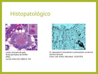 Histopatológico
Lesão ulcerada de pele.
Ácido periódico de Shiffer
(PAS)
Lancet Infect Dis 2008; 8: 734
H. capsulatum intracelular e extracelular na derme
Gomori-Grocott
Front. Cell. Infect. Microbiol. 10:591974
 