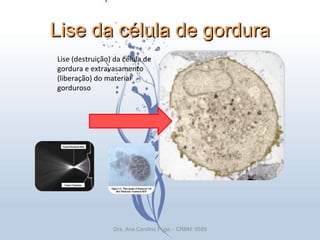 Lise da célula de gordura Dra. Ana Carolina Puga – CRBM: 5589 Lise (destruição) da célula de gordura e extravasamento  (liberação) do material gorduroso 