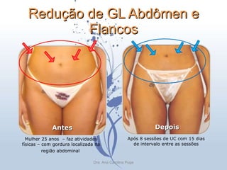 Redução de GL Abdômen e Flancos Antes Depois Mulher 25 anos  – faz atividades físicas – com gordura localizada na região abdominal   Após 8 sessões de UC com 15 dias de intervalo entre as sessões Dra. Ana Carolina Puga 